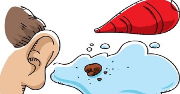 Använder du bomullstopps för att rengöra öronen? I så måste du sluta GENAST! Använder du bomullstopps för att rengöra öronen? I så måste du sluta GENAST!