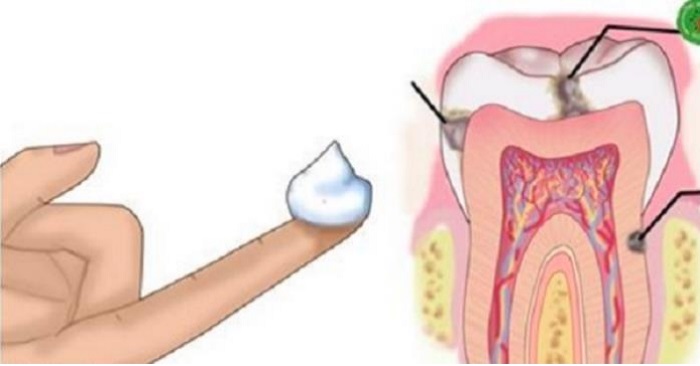 Varför berätta inte tandläkare DETTA? Denna enkla metod bekämpar hål med något du har hemma!